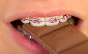 can you eat chocolate with braces